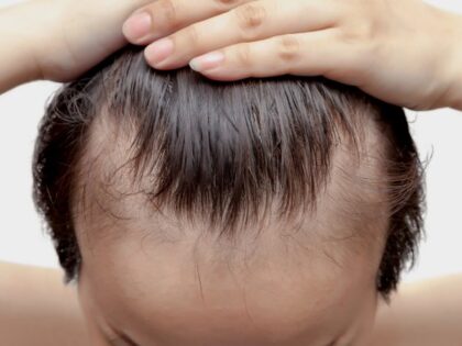 Łysienie androgenowe – jak je rozpoznać, zatrzymać i kiedy działać?